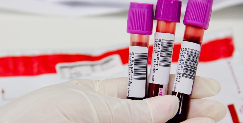 Novo exame de sangue ajuda a detectar Alzheimer e demência